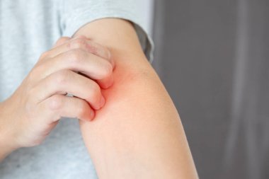 Genç Asyalı adam kaşınıyor ve kolunda kaşındırıyor kuru cilt egzama dermatiti yüzünden.