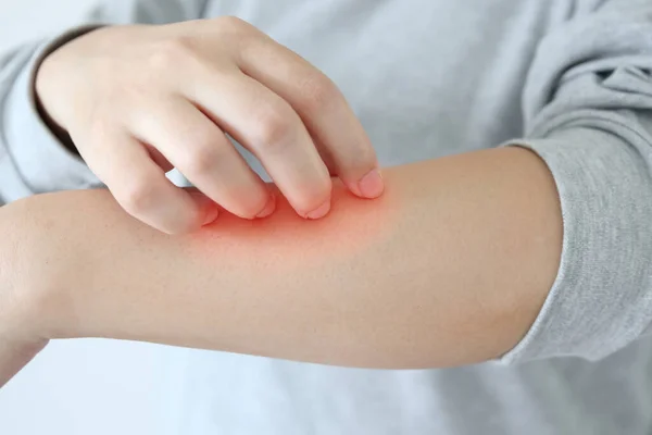 Young Asian Woman Itching Scratching Arm Itchy Dry Skin Eczema — Stock Photo, Image