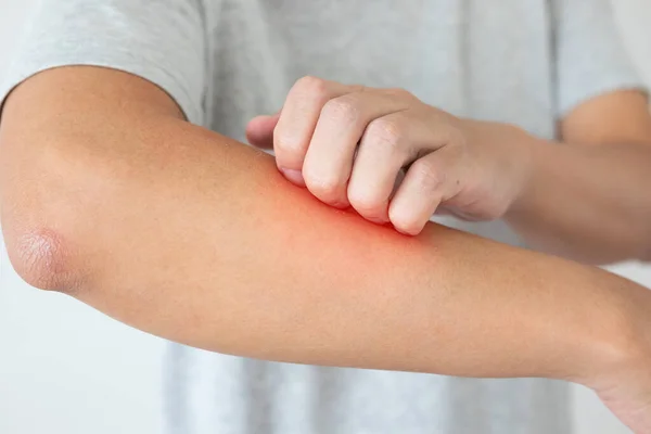 Jonge Aziatische Man Jeuk Krassen Arm Van Jeukende Droge Huid — Stockfoto