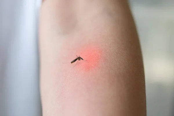 Δάγκωμα Κουνουπιού Ενήλικο Χέρι Δερματικό Εξάνθημα Και Αλλεργία Κόκκινη Κηλίδα — Φωτογραφία Αρχείου