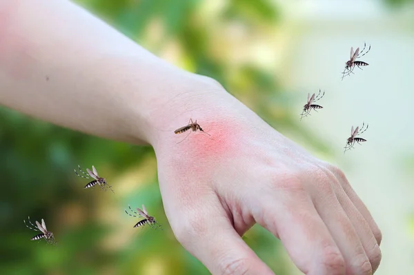 Picadura Mosquitos Piel Adulta Hecha Mano Erupción Alergia Con Manchas — Foto de Stock