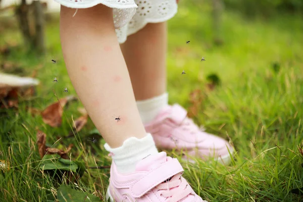 Carino Asiatico Bambina Pelle Eruzione Cutanea Allergia Zanzara Mordere Succhiare — Foto Stock