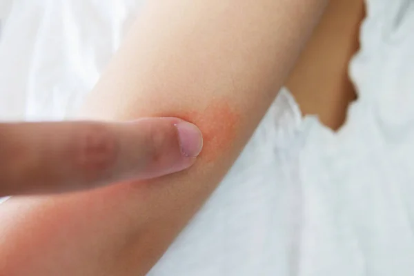 Anya Alkalmazása Antiallergén Krém Baby Kar Bőrkiütés Allergia Vörös Folt — Stock Fotó