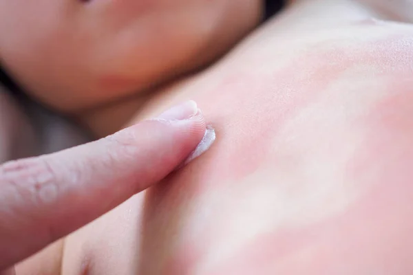 Doctor Hand Applying Topical Antihistamine Medicine Cream Little Girl Body — Stock Photo, Image