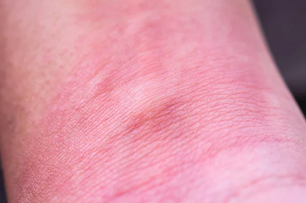 Skin Allergy Rash Mosquito Bite — Stock Photo, Image