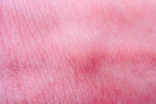 Skin Allergy Rash Mosquito Bite — Stock Photo, Image