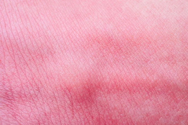 Skin Allergy Rash Mosquito Bite — Stock Photo, Image