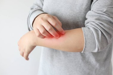 Genç Asyalı kadın kaşındırıyor ve kollarını kaşındırıyor kuru cilt egzama dermatiti yüzünden.