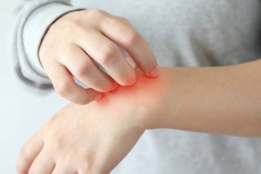 Genç Asyalı kadın kaşındırıyor ve kollarını kaşındırıyor kuru cilt egzama dermatiti yüzünden.