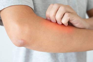 Genç Asyalı adam kaşınıyor ve kolunda kaşındırıyor kuru cilt egzama dermatiti yüzünden.