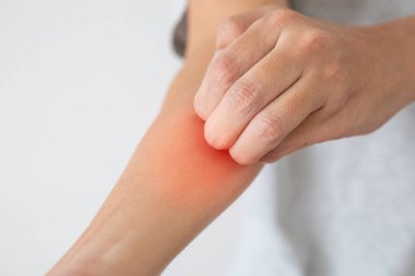 Genç Asyalı adam kaşınıyor ve kolunda kaşındırıyor kuru cilt egzama dermatiti yüzünden.