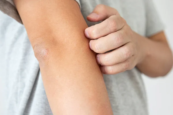 Joven Asiático Hombre Picazón Arañazos Brazo Picazón Piel Seca Eczema —  Fotos de Stock