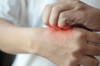 Elinde kaşınan ve böcek ısırığından dolayı kaşınan bir adam veya cildinde egzama derisi iltihabı var.