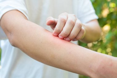Alerji yüzünden kaşınan ve kollarında kaşıntı olan bir adam var.