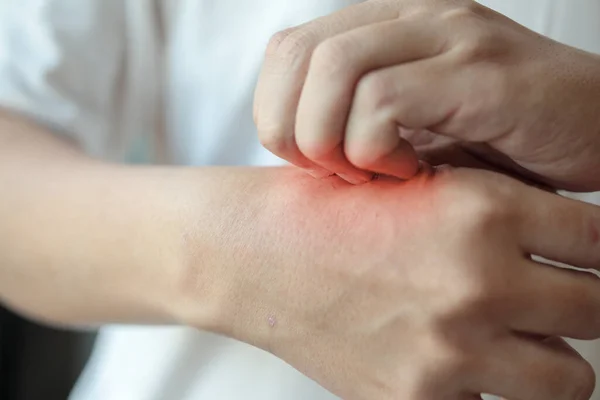 Man Jeuk Krabben Hand Van Insectenbeet Jeukende Droge Huid Eczeem — Stockfoto