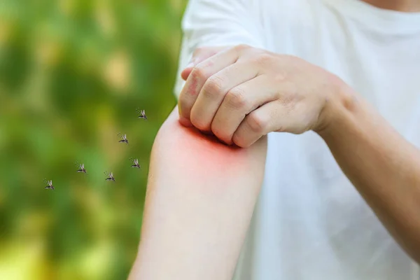 Man Itching Scratching Arm Allergy Skin Rash Cause Mosquitoes Bite — Stock Photo, Image