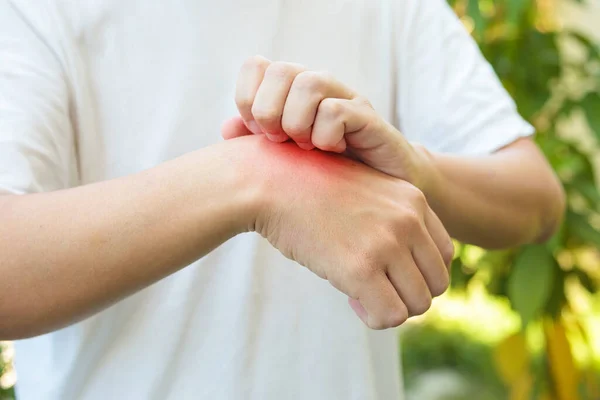 Man Itching Scratching Hand Allergy Skin Rash Cause Insect Bite — Stock Photo, Image