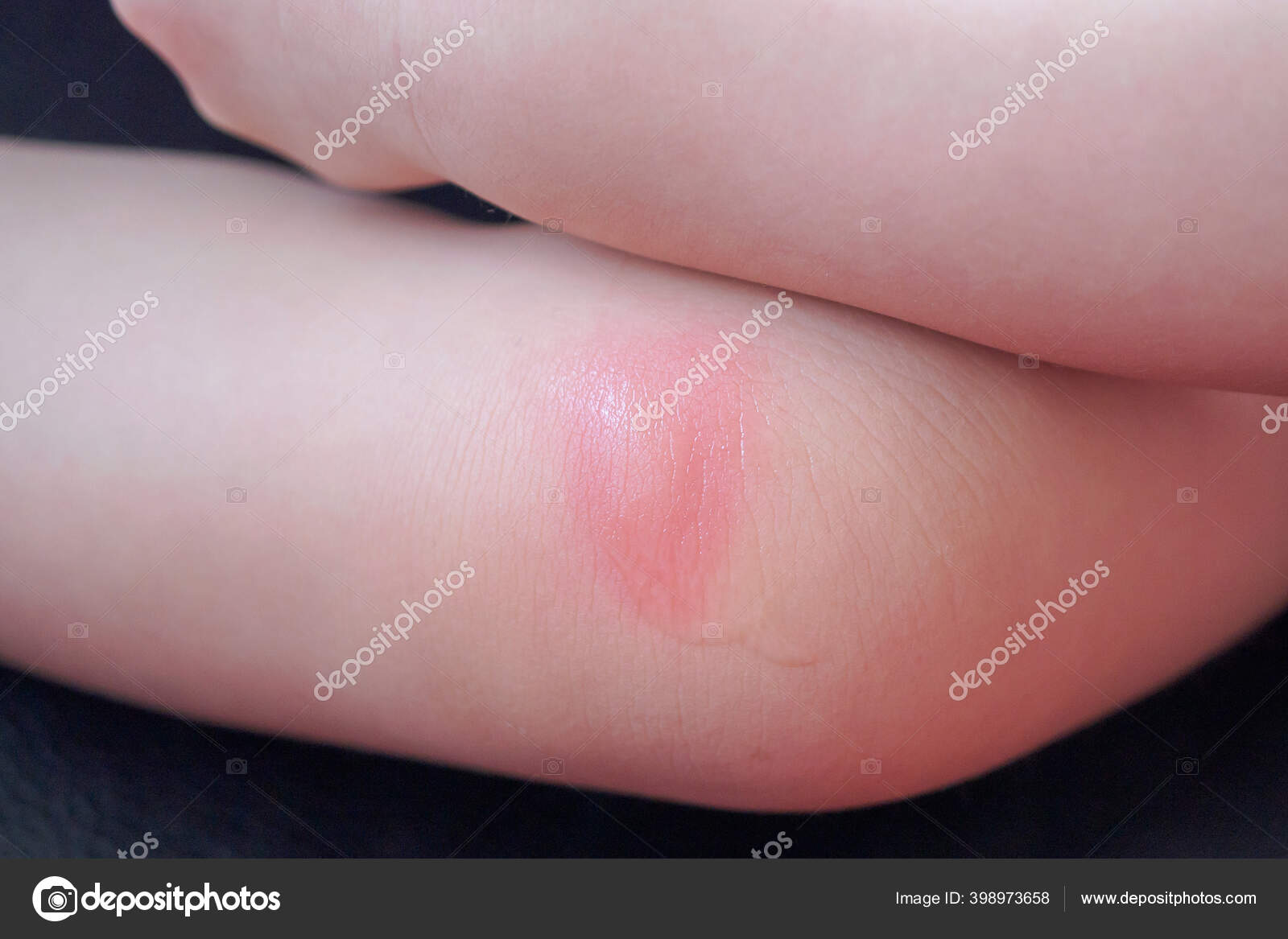 Eruption Cutanee Allergie Bebe Avec Une Tache Rouge Causee Par Image Libre De Droit Par Kwangmoo C