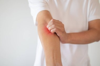 Kaşındıran ve kaşındıran bir adam kaşındıran kuru cilt egzama dermatiti.