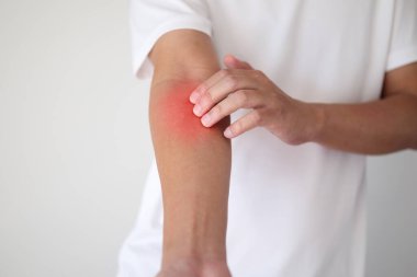 Kaşındıran ve kaşındıran bir adam kaşındıran kuru cilt egzama dermatiti.
