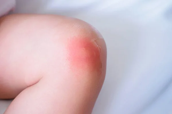 Сыпь Коже Ребенка Аллергия Красным Пятном Вызванная Укусом Комара Колене — стоковое фото