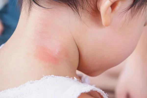 Baby Skin Rash Allergy Red Spot Cause Mosquito Bite Neck — Stock Photo, Image