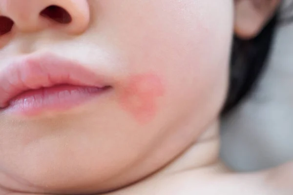 Klein Aziatisch Meisje Huiduitslag Allergie Met Rode Vlek Veroorzaakt Door — Stockfoto