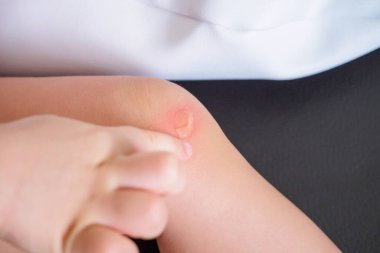 Bebek cildinde kızarıklık ve kırmızı lekeye alerjisi var.