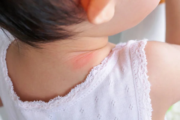 Сыпь Коже Ребенка Аллергия Красным Пятном Вызванная Укусом Комара Шее — стоковое фото