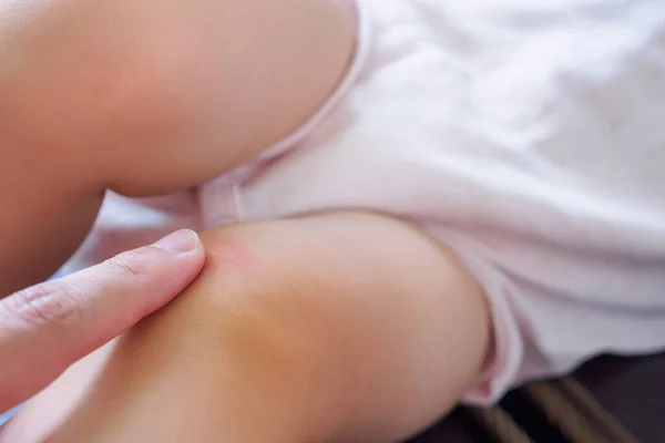 Madre Aplicando Crema Antialérgica Rodilla Del Bebé Con Erupción Cutánea — Foto de Stock