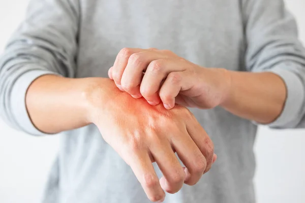 Young asian man itching and scratching on hand from itchy dry skin eczema dermatitis