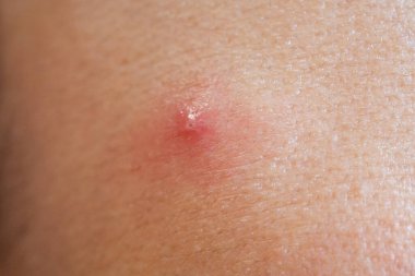 Yüzünde kırmızı lekeler olan kışkırtıcı sivilceler.