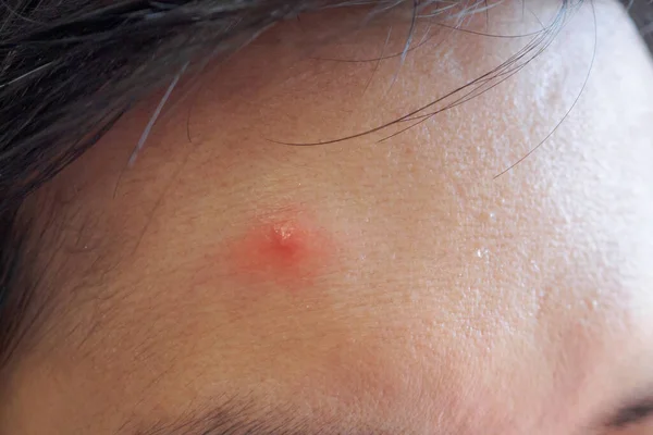 Inflammatory Acne Red Spot Face Closeup — Stock Photo, Image