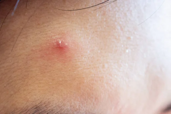 Inflammatory Acne Red Spot Face Closeup — Stock Photo, Image