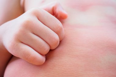 Küçük Asyalı bebek vücudunda kaşıntılı ve alerjik bir kaşıntı var.