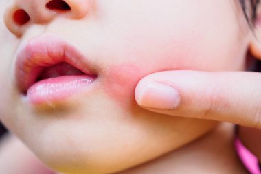 Anne, çocuğun yüzüne topikal antihistamin kremi sürüyor. Cilt isiliği ve kırmızı lekeye alerjisi var. Sivrisinek ısırığından kaynaklanıyor.