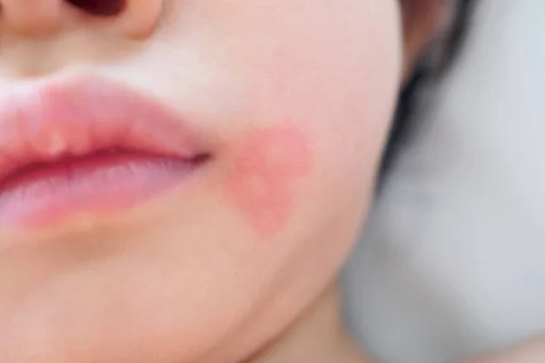 Mała Azjatycka Dziewczyna Wysypka Skórna Alergia Czerwoną Plamą Spowodowane Przez — Zdjęcie stockowe