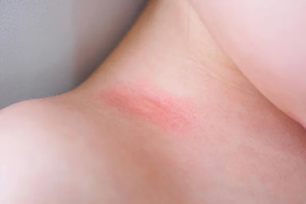 Poco Asiático Chica Piel Erupción Alergia Con Rojo Punto Causa —  Fotos de Stock