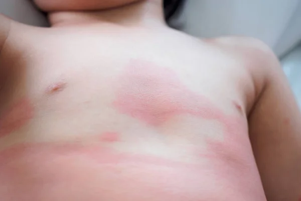Сыпь Коже Экземой Аллергическая Реакция Маленькое Азиатское Детское Тело Вызваны — стоковое фото
