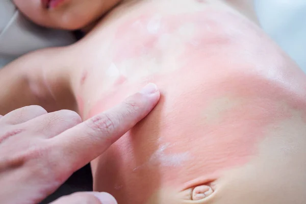 Doctor Hand Applying Topical Antihistamine Medicine Cream Little Girl Body — Stock Photo, Image