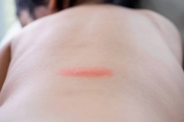 Kis Ázsiai Lány Bőr Kiütés Allergia Vörös Folt Okozta Szúnyogcsípés — Stock Fotó