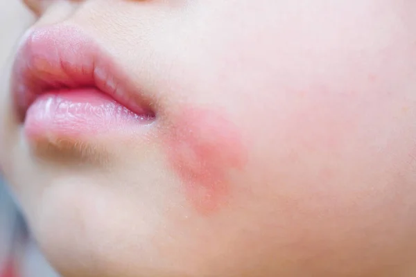 Kis Ázsiai Lány Bőrkiütés Allergia Vörös Folt Okozta Szúnyogcsípés Arcon — Stock Fotó