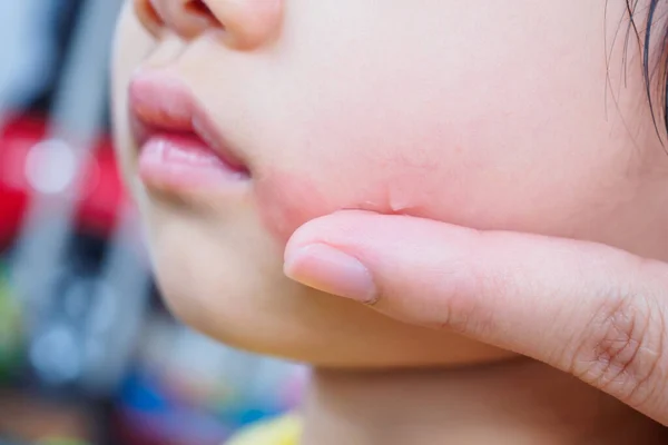 Moeder Die Actuele Antihistaminicum Crème Het Gezicht Van Het Kind — Stockfoto