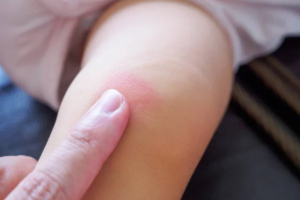 Mãe Aplicando Creme Antialérgico Joelho Bebê Com Erupção Cutânea Alergia — Fotografia de Stock