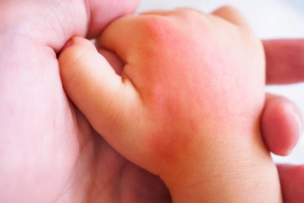Mão Bebê Com Erupção Cutânea Alergia Com Causa Mancha Vermelha — Fotografia de Stock