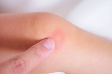Anne, bebek dizine alerjik krem sürüyor. Cilt isiliği ve kırmızı lekeye alerjisi var. Sivrisinek ısırığından kaynaklanıyor.
