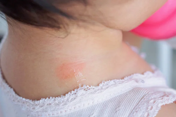 Csecsemő Bőrkiütés Allergia Vörös Folttal Okozta Szúnyogcsípés Nyakon — Stock Fotó