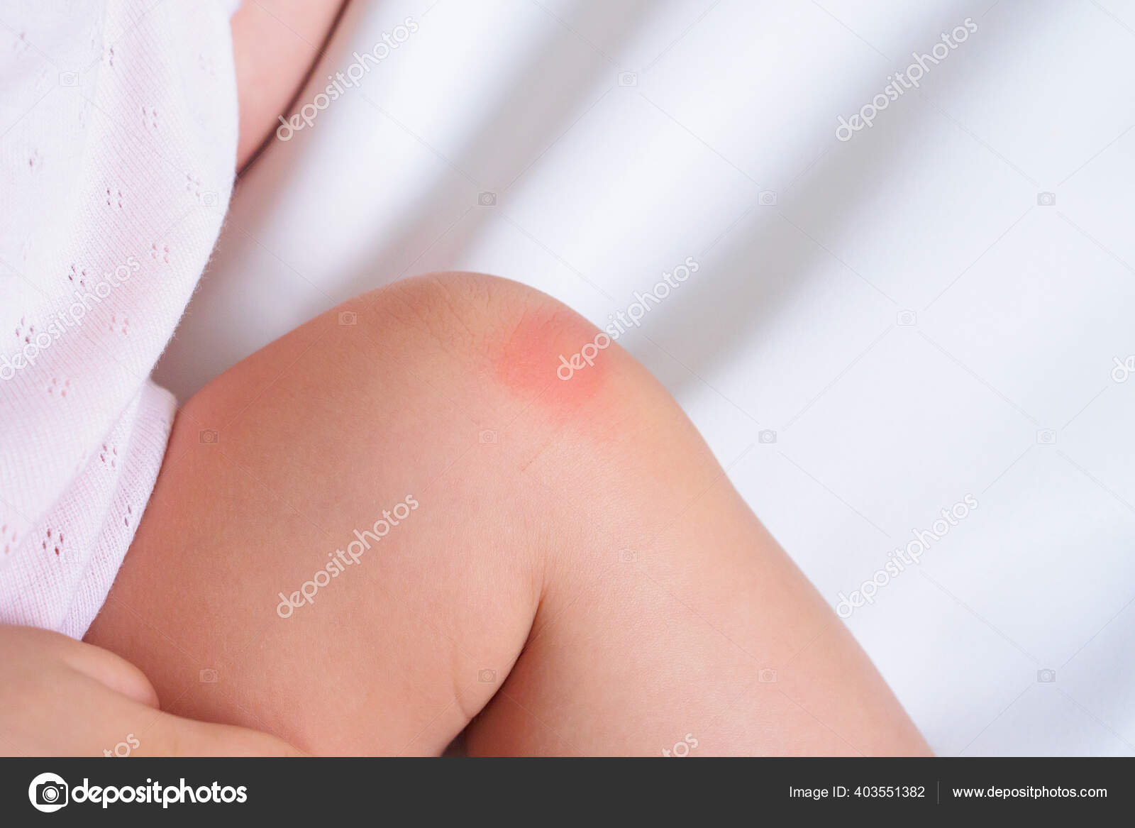 Baby Skin Rash Allergy Red Spot Cause Mosquito Bite Knee Stock Photo By C Kwangmoo