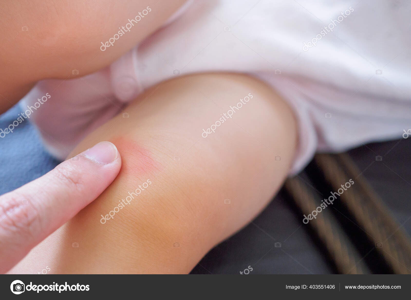 Mother Applying Antiallergic Cream Baby Knee Skin Rash Allergy Red Stock Photo By C Kwangmoo