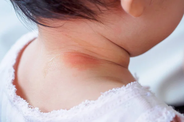 Erupção Cutânea Bebê Alergia Com Causa Mancha Vermelha Por Picada — Fotografia de Stock